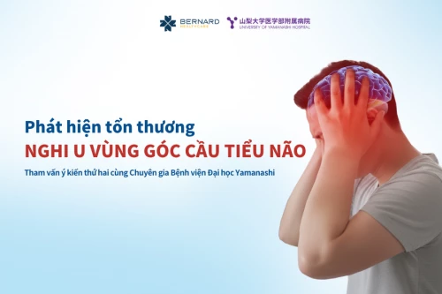 Phát hiện tổn thương nghi u ở vùng góc cầu tiểu não qua tầm soát chuyên sâu ung thư chuẩn Nhật tại Bernard